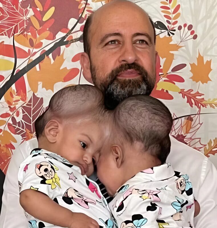 Las hermanas nacieron compartiendo una sola cabeza entre las dos, pero cuando cumieron 3 años, los médicos las separaron: así lucen hoy