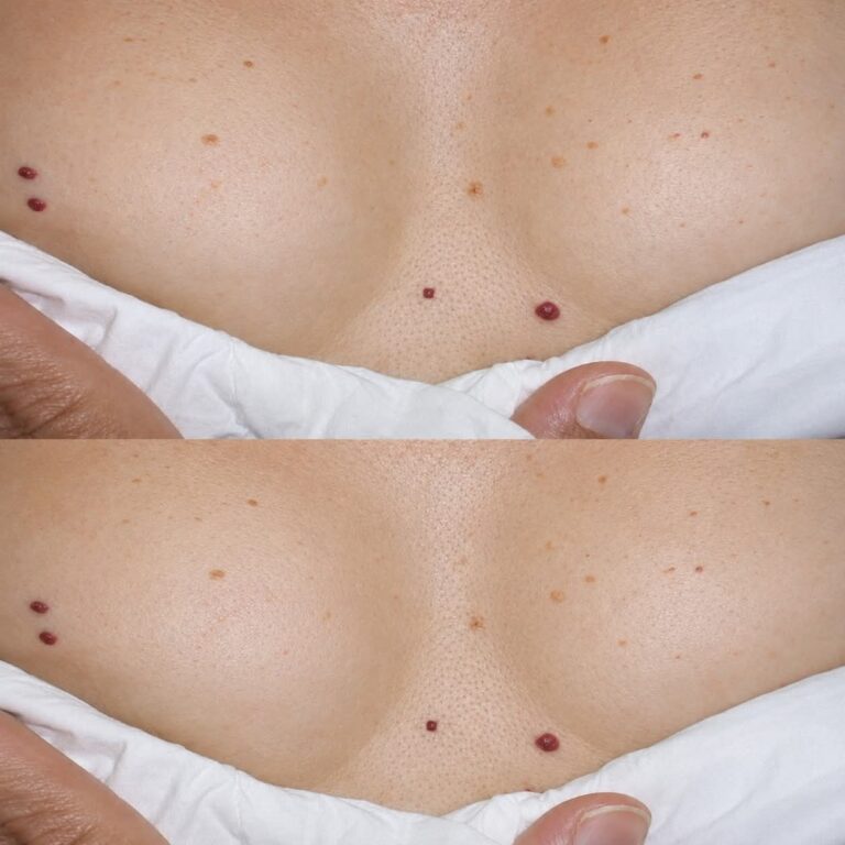 ¿Te han salido puntos rojos en la piel? Esto es lo que tu cuerpo podría estar intentando decirte