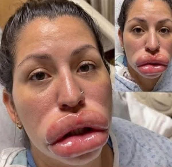 Mujer denuncia presunta negligencia médica tras procedimiento estético