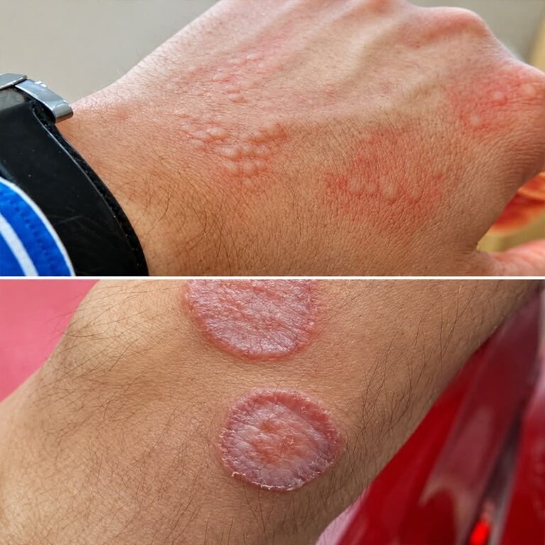 Dermatitis en las manos: cuando la piel habla más fuerte que las palabras