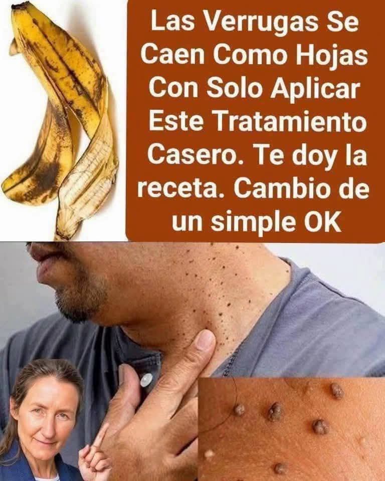 Eliminar verrugas fibromas, espinillas y manchas