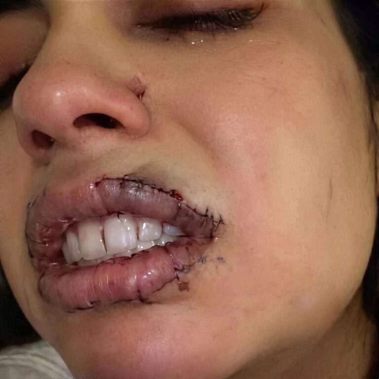 Mujer escapa con los labios cosidos y pide ayuda en Japón: qué ocurrió y cómo avanza el caso
