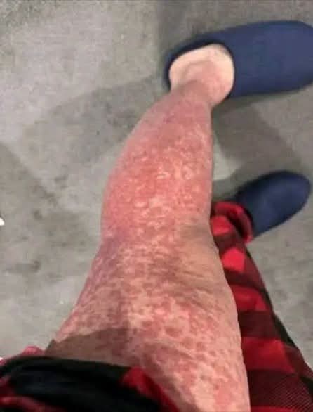 Manchas rojas en las piernas: por qué aparecen, qué pueden significar y cómo cuidarlas