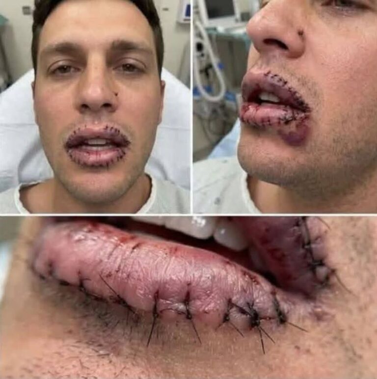 Boca hinchada después de comer pollo frito: cuándo puede ser una alergia y qué hacer